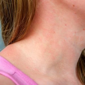 Things that look like hickeys but aren’t- The perfect hickey’s guide;