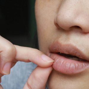Dry Lips Vitamin Deficiency: What You Need to Know